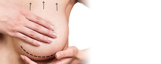 جراحة رفع الثدي