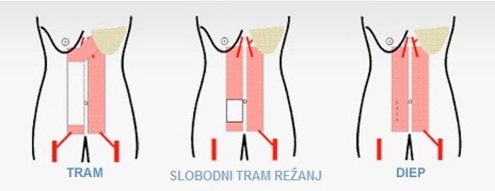 Rekonstrukcija grudi