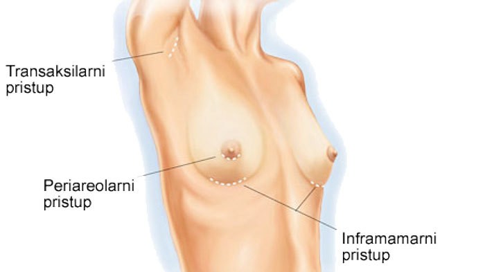 تكبير الثدي تكبير الثدي