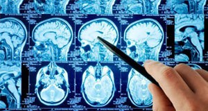 Minimalno invazivna neurohirurgija