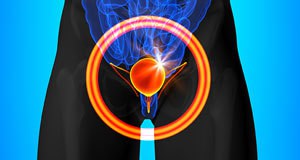 Tumori mokraćnje bešike