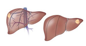 جراحة الكبد