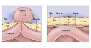Hirurgija kile Operacija kile
