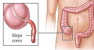 Hirurgija slepog creva
