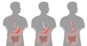 جراحة المعدة والمريء جراحة المعدة والمريء