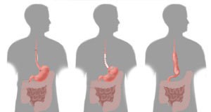 Hirurgija želuca jednjaka Operacija želuca i jednjaka