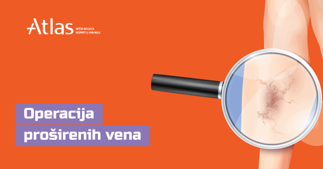 operacija prosirenih vena Atlas bolnica