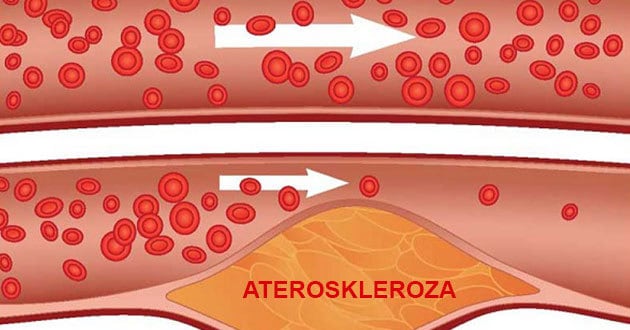 Ateroskleroza