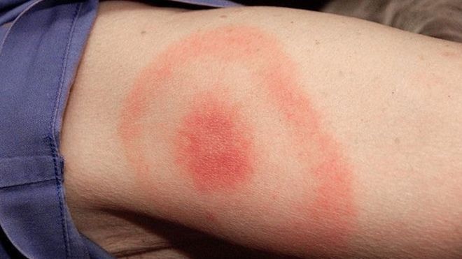 erythema migrans - Lajamska bolest