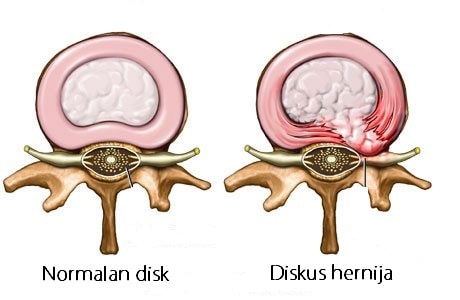 Diskus hernija