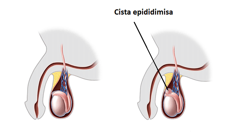 Cista epididimisa - spermatokela