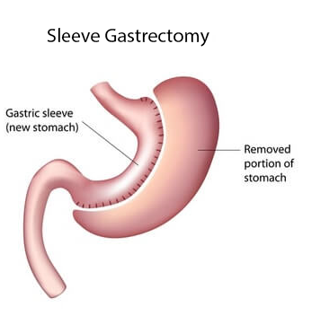gastric-sleeve atlas hospital