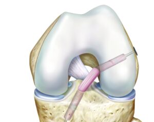 Anterior cruciate ligament reconstruction - ACL