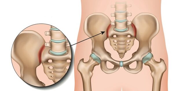 Sakroilijačni zglob