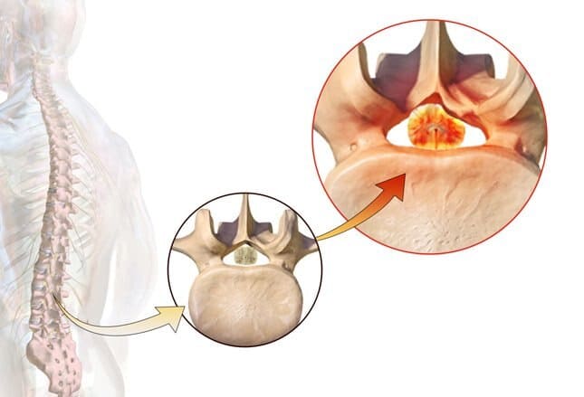 pinched nerve in spine pinched nerve in spine