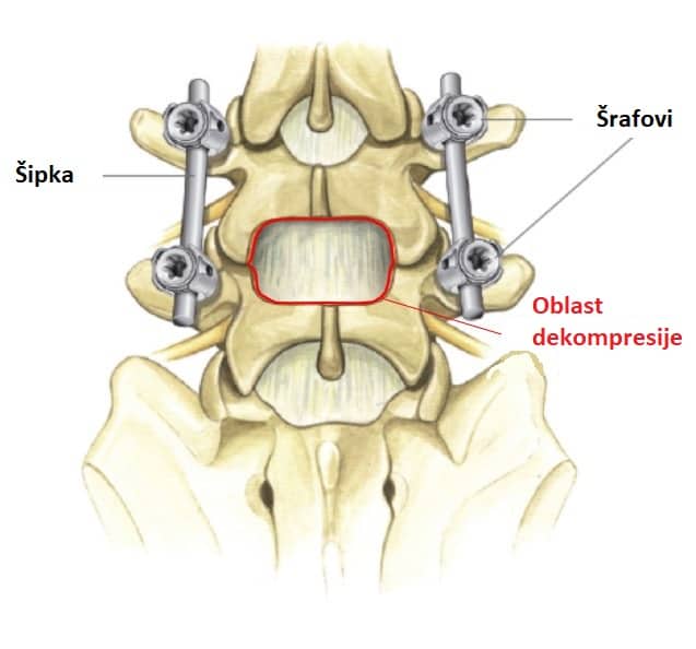 spinal fusion - spine surgery spinal fusion - spine surgery