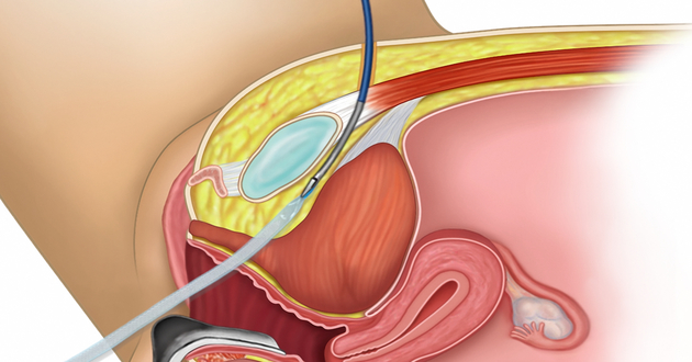 tot tretman mrežicom kod nevoljnog umokravanja tot tretman mrežicom kod nevoljnog umokravanja