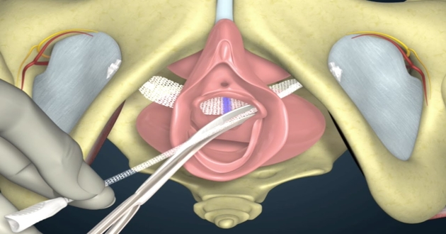 Tot tretman mrežicom Tot tretman mrežicom