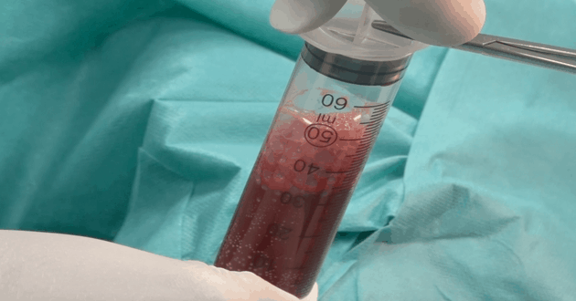 matične ćelije za lečenje povreda zglobova