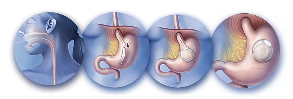 Plasiranje balona za mršavljenje