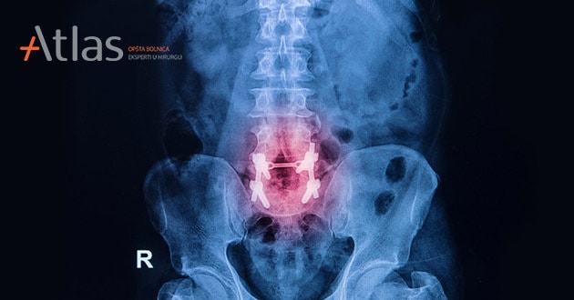 Prelom kičmenog pršljena